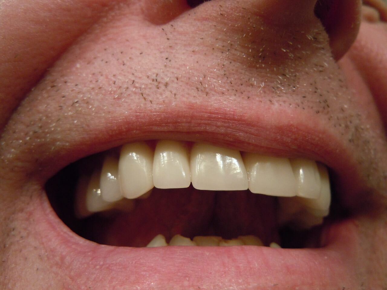 Ból po wybieleniu zębów - co robić?